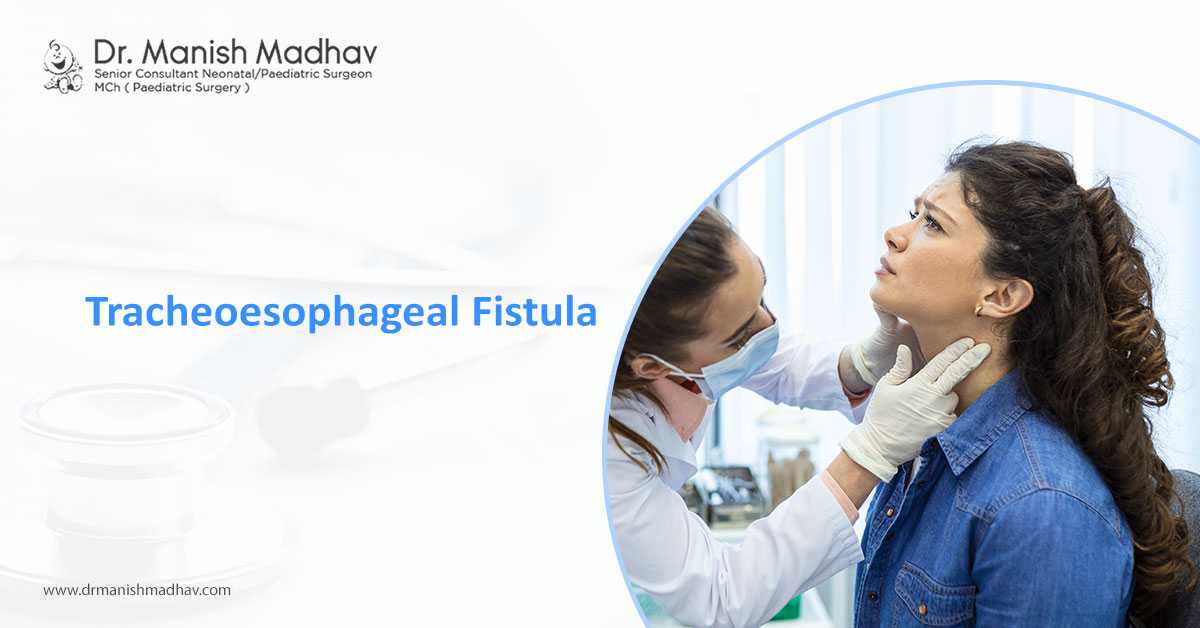Tracheoesophageal Fistula