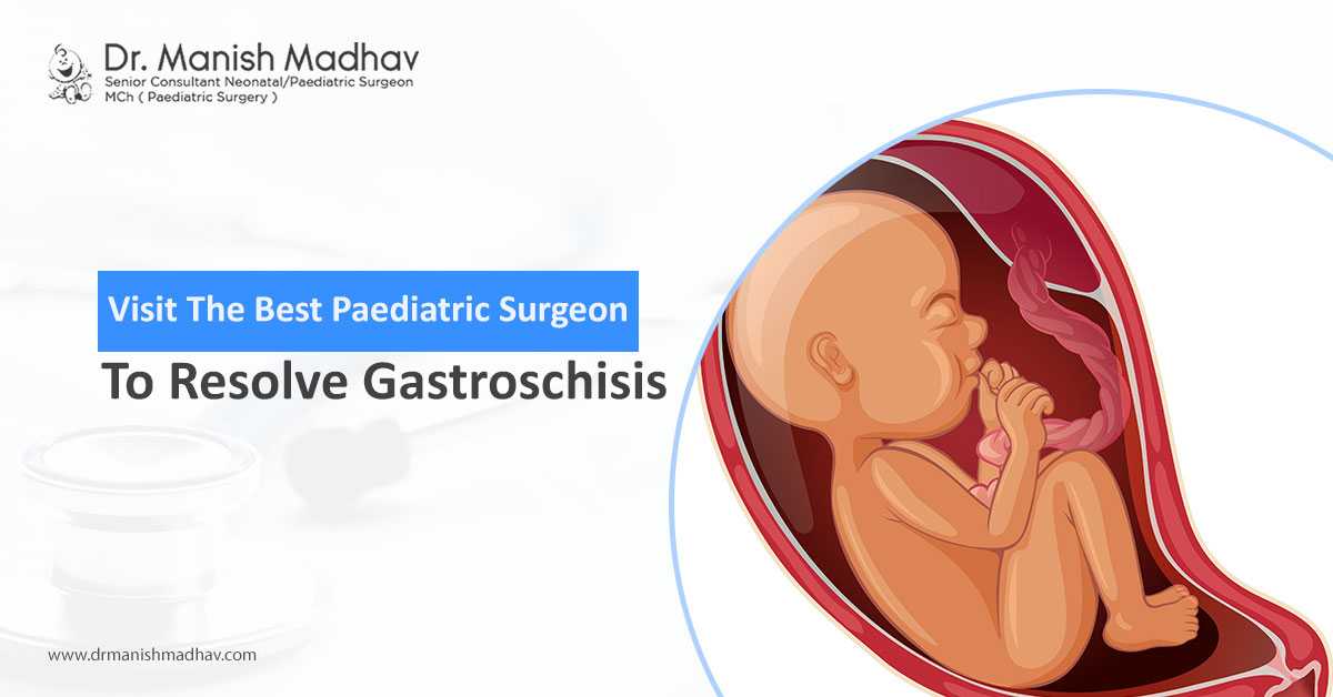 Visit The Best Paediatric Surgeon To Resolve Gastroschisis
