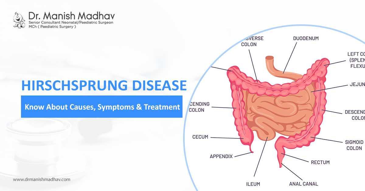 Know About Hirschsprung Disease
