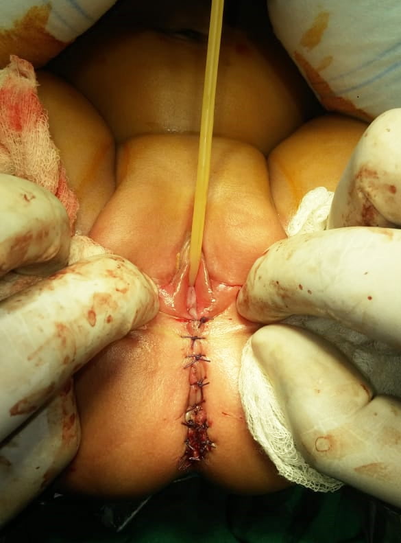 Recto vestibular fistula surgery ASARP 
