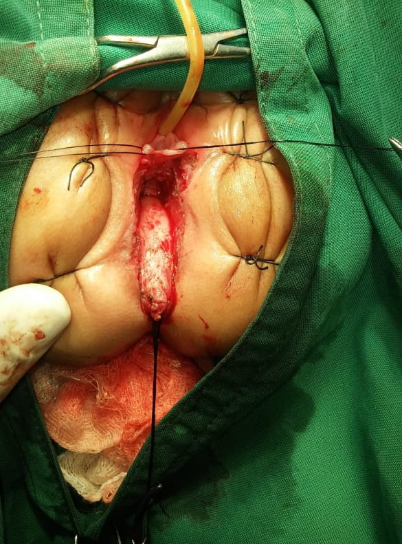 fistula surgery ASARP 