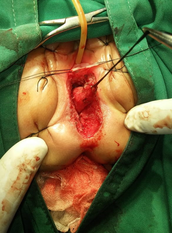 fistula surgery ASARP 