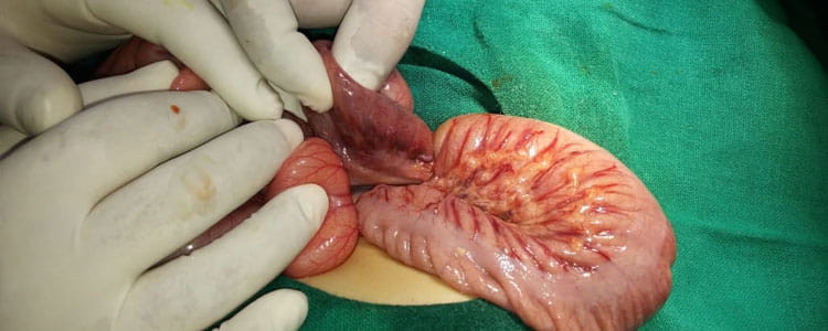 Intussusception Surgery